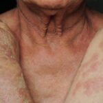 Dermatitis Atopik Adalah Gejala, Penyebab dan Pengobatan yang Direkomendasikan