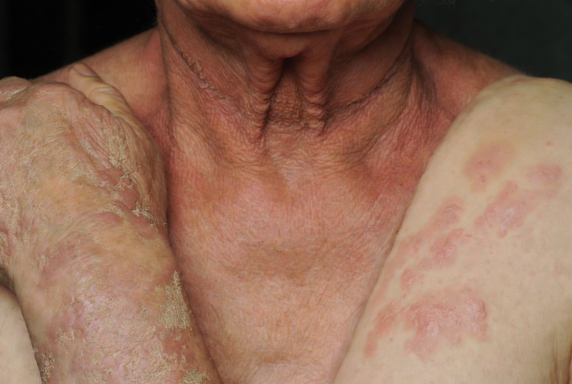 Dermatitis Atopik Adalah Gejala, Penyebab dan Pengobatan yang Direkomendasikan